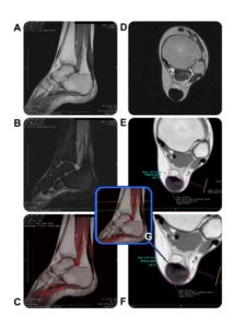 Figure 2. MRI of the patient’s left ankle post-operatively, performed on a Hitachi 0.3 Tesla device. The name of the patient has been blacked out. T1 images used for calculations were both performed with a TE of 20, and a TR of 820, utilizing 5.5 mm slice thicknesses. Color fusion with OsiriX Imaging Software. A.Sagittal T1 left ankle B.STIR Sagittal left ankle C.Sagittal T1 fused with a sagittal STIR left ankle D.Axial T1 left ankle E.Axial T2 Fast Spin Echo left ankle F.Axial T1 zoomed to better show the image measurement of signal intensity and area of involved tissue left ankle G.Scout view – center green line represents the image slice in F taken at the most involved portion of the tendon—left ankle Special thanks to Dr. Paul Marsh, D.O. of Monticello Diagnostic Imaging for compiling this images.