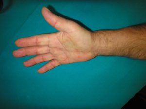 Figure 6. Absence of contracture after collagenase injection.