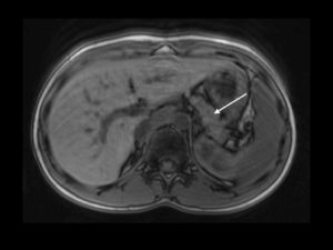 Figure 1. Magnetic resonance (MRI) cross-sectional imaging showing relatively atrophic pancreas (white arrow) and absence of pancreatic ductal dilatation.