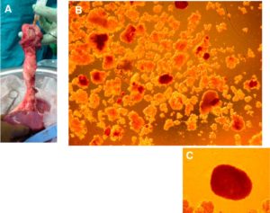 Figure 4. A, Cannulation of the main pancreatic duct after cooling of the pancreas/spleen explant for Case 3 on the back-table. B, Unpurified islet preparation stained with dithizone. Islets stained in red. C, Close-up of single large intact islet measuring 500 µm in diameter.
